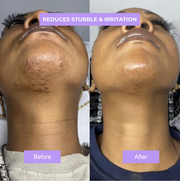 Embrace Smooth, Confident Skin Every Day